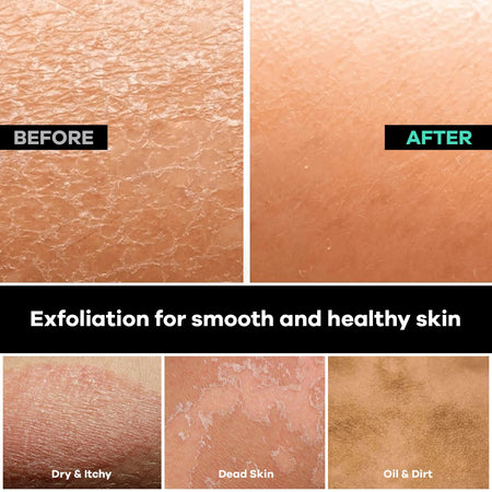 Dermasuri exfoliating back scrubber removes dry and flaky skin, leaving your back smooth and healthier.